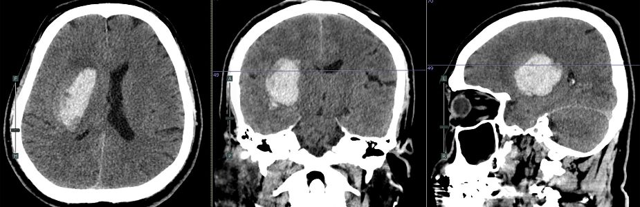 Craniotomy & Brain-Tumour Surgery