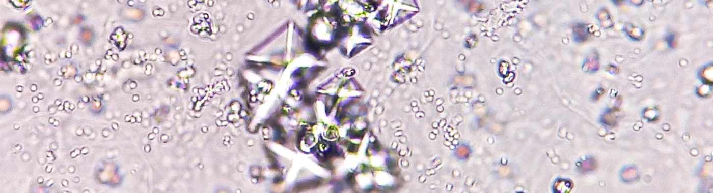 Crystals In Urine - Causes, Symptoms, Diagnosis, Treatment, and Prevention