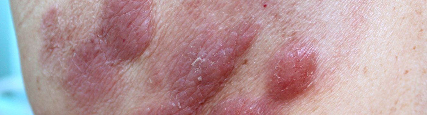 Cutaneous T-Cell Lymphoma - Early Signs, Risk Factors, Diagnosis, and Treatment Explained