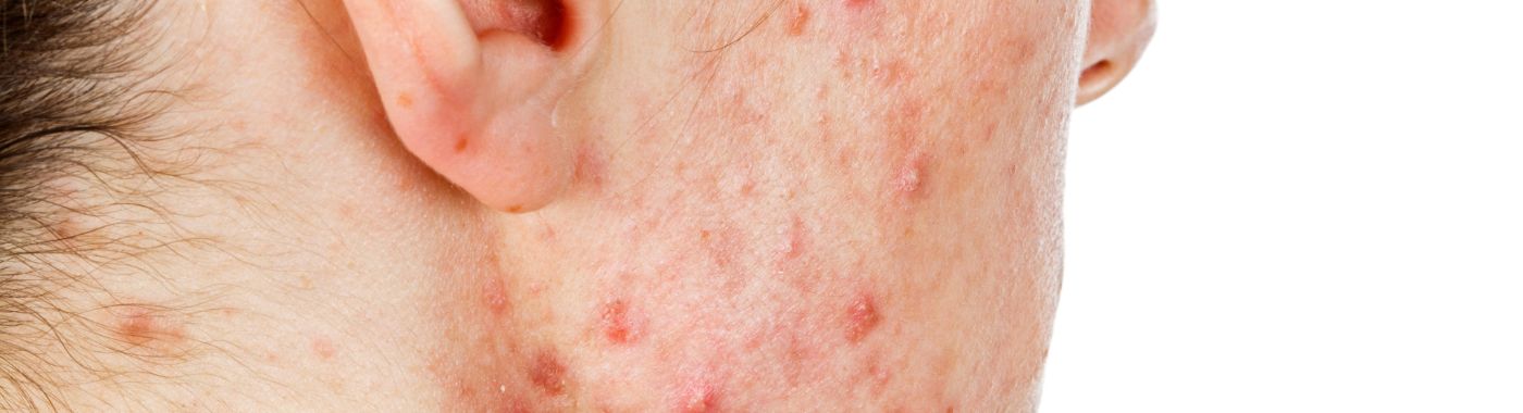 Cystic Acne - Causes, Symptoms, Diagnosis, Treatment, and Prevention