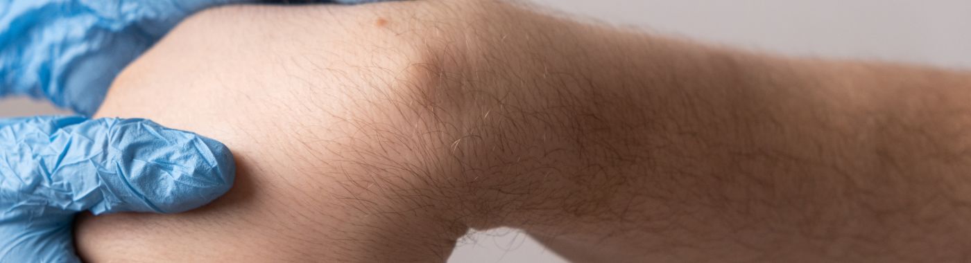 Cystic Hygroma - Causes, Symptoms, Diagnosis, Treatment, and Prevention