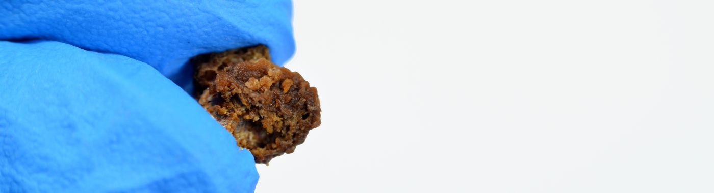 Cystine Stones - Causes, Symptoms, Diagnosis, Treatment, and Prevention