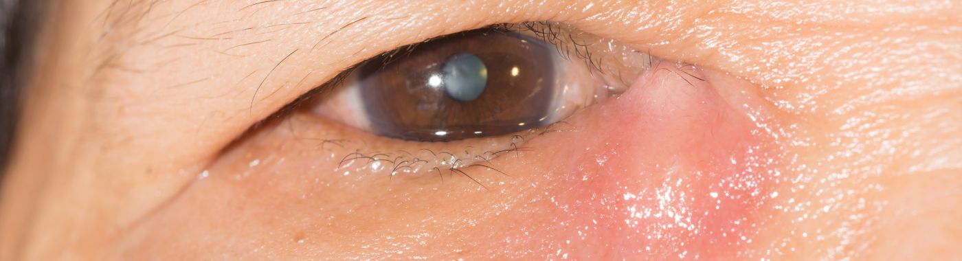 Dacryocystitis - Causes, Symptoms, Diagnosis, Treatment, and Prevention