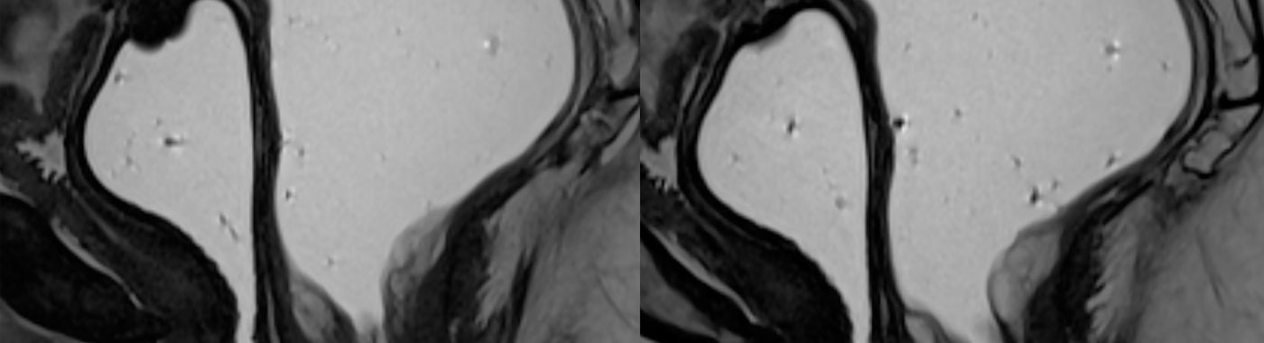 Defecography - Causes, Symptoms, Diagnosis, Treatment, and Prevention