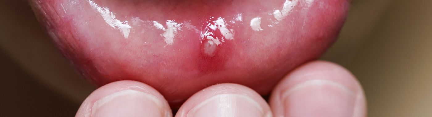 Denture Stomatitis - Causes, Symptoms, Diagnosis, Treatment, and Prevention