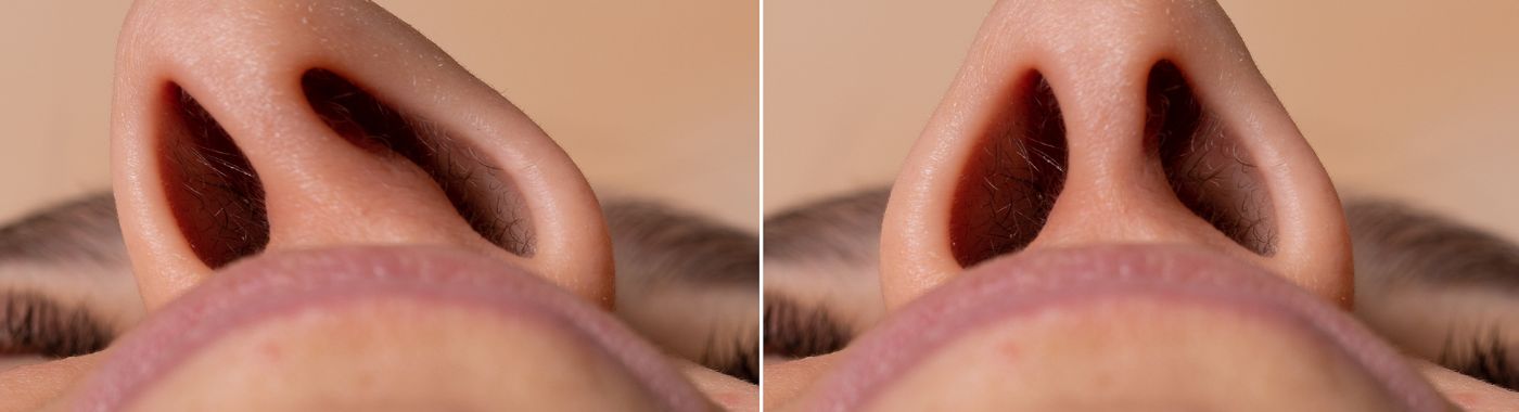 Deviated nasal septum