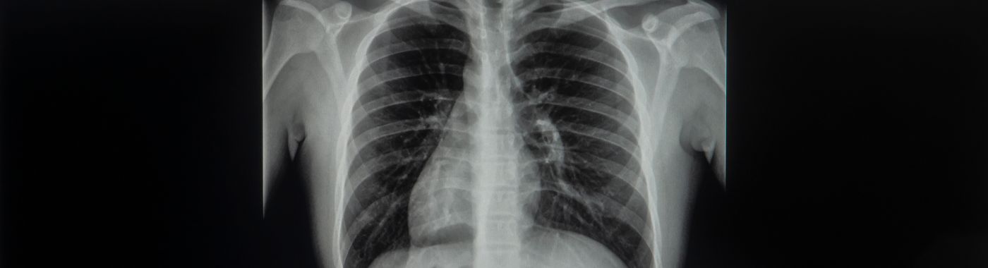Dextrocardia - Causes, Symptoms, Diagnosis, Treatment, and Prevention