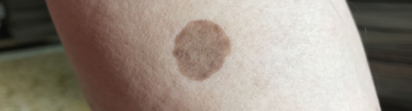 Diabetic Dermopathy - Causes, Symptoms, Diagnosis, Treatment, and Prevention