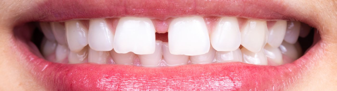 Diastema - Causes, Symptoms, Diagnosis, Treatment, and Prevention