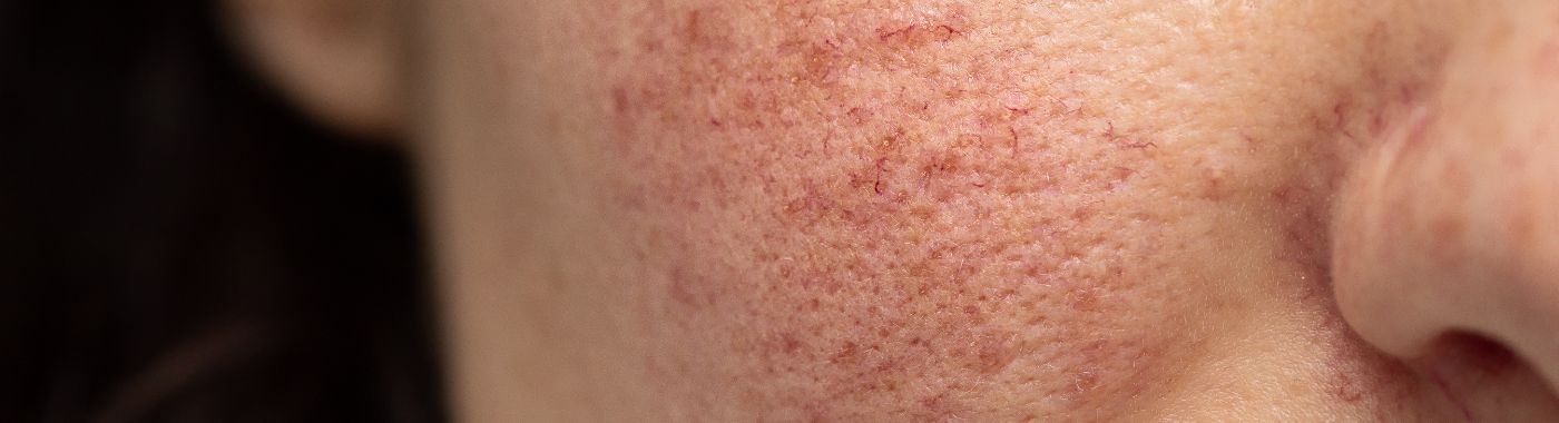 Dilated Pore Of Winer - Causes, Symptoms, Diagnosis, Treatment, and Prevention