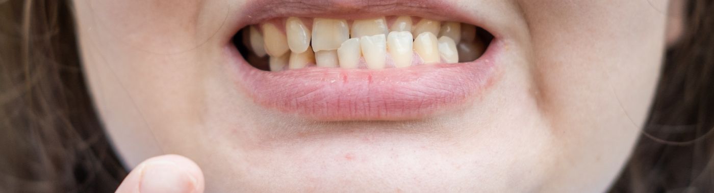 Dislocated Jaw - Causes, Symptoms, Diagnosis, Treatment, and Prevention