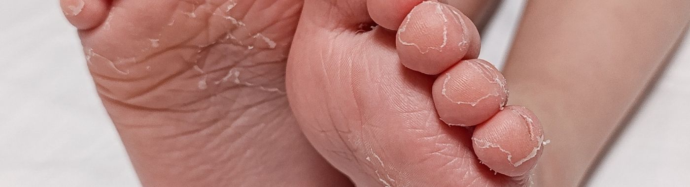 Dyshidrosis - Causes, Symptoms, Diagnosis, Treatment, and Prevention