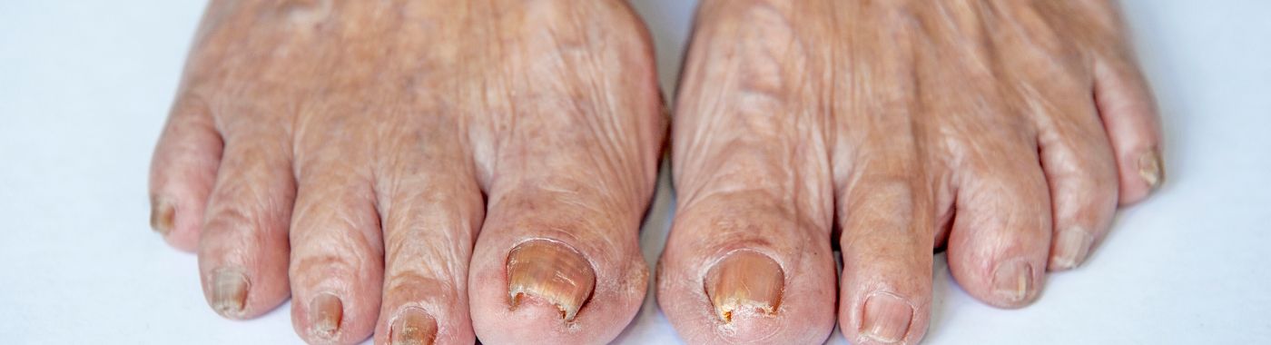 Dystrophic Nails - Causes, Symptoms, Diagnosis, Treatment, and Prevention