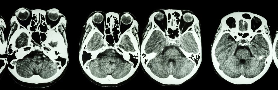 Endoscopic Skull-Base Surgery / Endonasal Approach