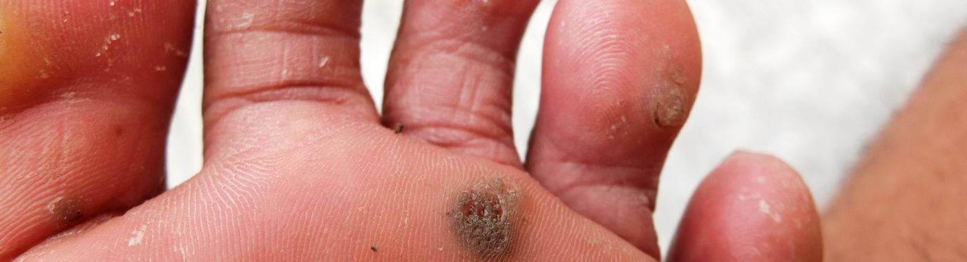 Eosinophilic Fasciitis - Causes, Symptoms, Diagnosis, Treatment, and Prevention