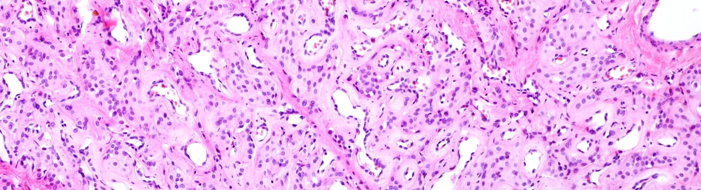 Epithelioid Hemangioendothelioma - Causes, Symptoms, Diagnosis, Treatment, and Prevention
