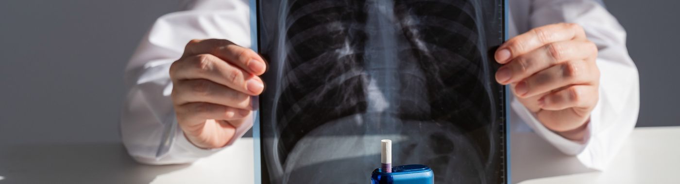 Evali - Causes, Symptoms, Diagnosis, Treatment, and Prevention