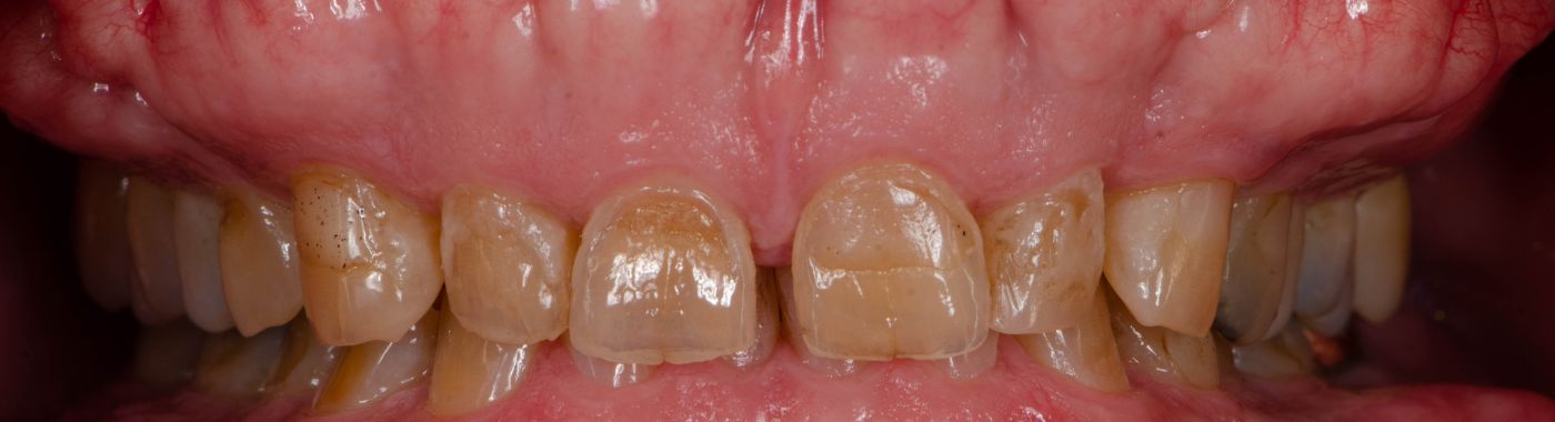 Exostosis - Causes, Symptoms, Diagnosis, Treatment, and Prevention