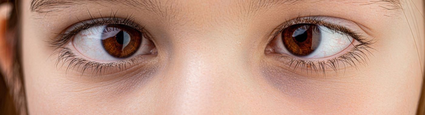 Exotropia - Causes, Symptoms, Diagnosis, Treatment, and Prevention
