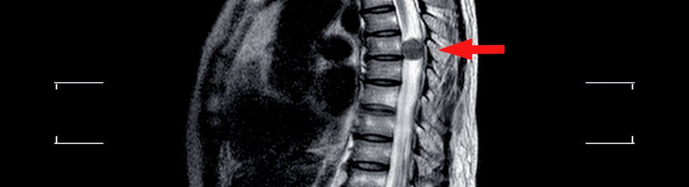 Extramedullary Tumors - Early Signs, Risk Factors, Diagnosis, and Treatment Explained