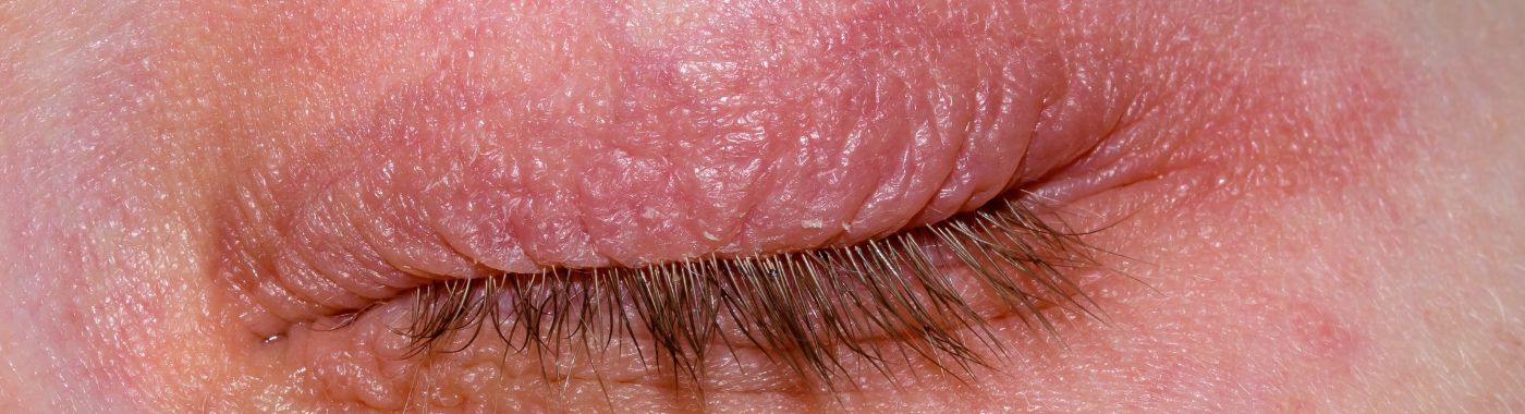 Eyelid Dermatitis - Causes, Symptoms, Diagnosis, Treatment, and Prevention