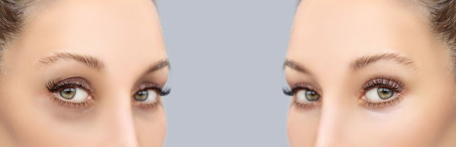 Facial Fat-Grafting / Fillers