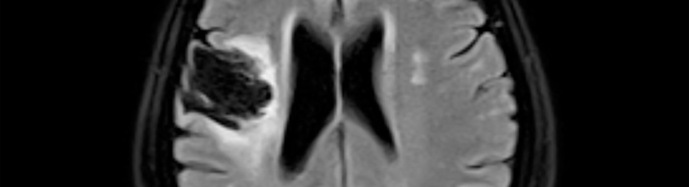 Fregoli Syndrome - Causes, Symptoms, Diagnosis, Treatment, and Prevention