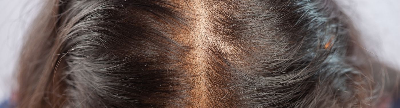 Frontal Fibrosing Alopecia - Causes, Symptoms, Diagnosis, Treatment, and Prevention