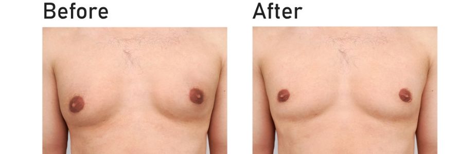 Gynecomastia Surgery (Male Chest Reduction)