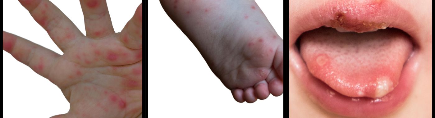 Hand Foot Mouth Disease - Causes, Symptoms, Diagnosis, Treatment, and Prevention