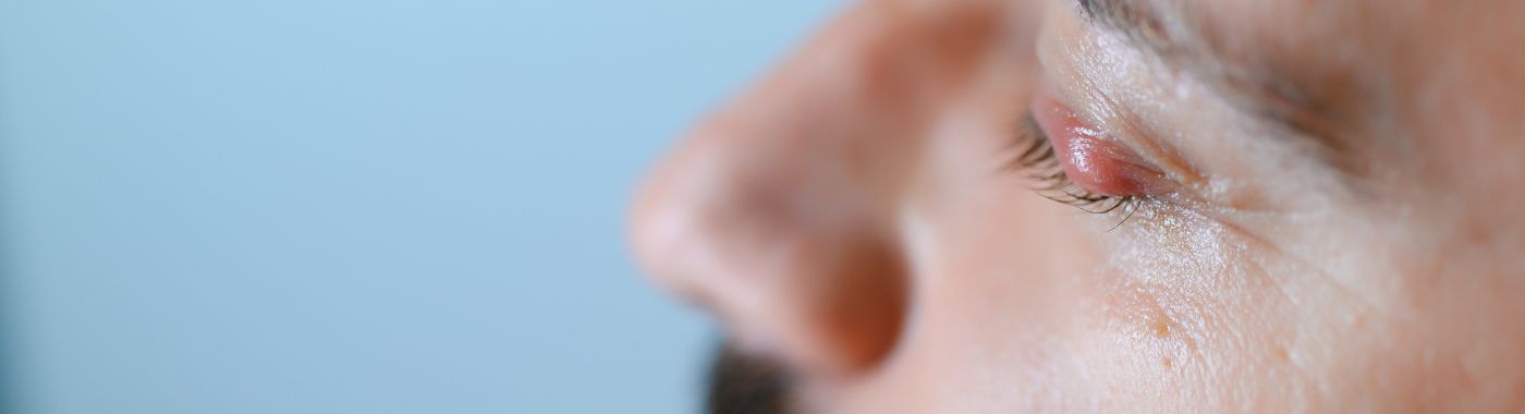 Histiocytoma - Causes, Symptoms, Diagnosis, Treatment, and Prevention