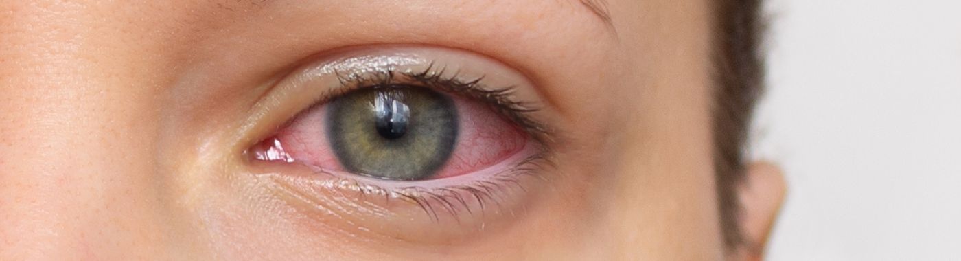 Hyphema - Causes, Symptoms, Diagnosis, Treatment, and Prevention