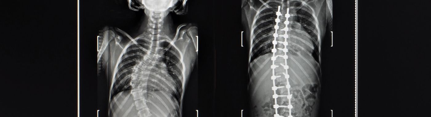 Idiopathic Scoliosis - Causes, Symptoms, Diagnosis, Treatment, and Prevention