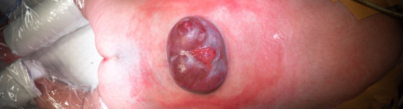 Iniencephaly - Causes, Symptoms, Diagnosis, Treatment, and Prevention