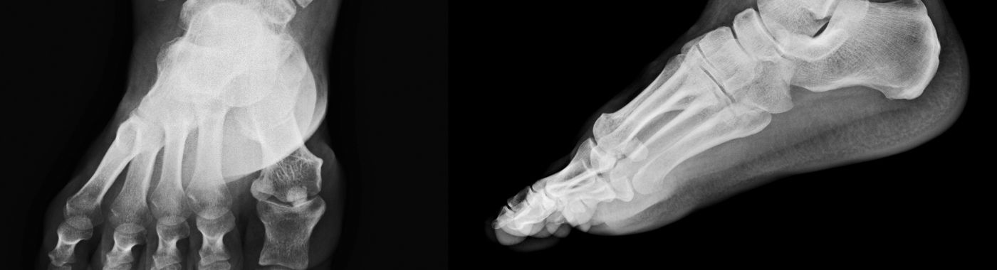 Intramedullary Tumors - Early Signs, Risk Factors, Diagnosis, and Treatment Explained