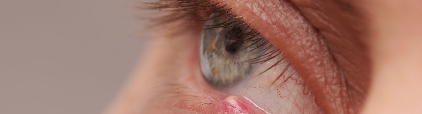 Lagophthalmos - Causes, Symptoms, Diagnosis, Treatment, and Prevention