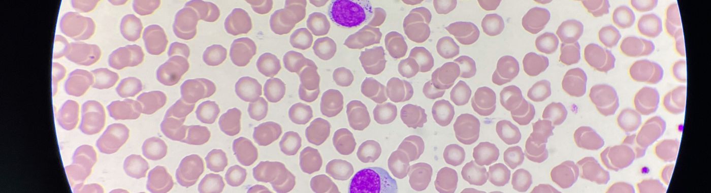 Large Granular Lymphocytic Leukemia - Causes, Symptoms, Diagnosis, Treatment, and Prevention