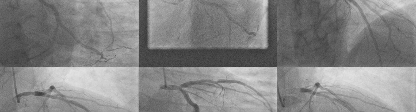 LMCA Disease - Causes, Symptoms, Diagnosis, Treatment, and Prevention