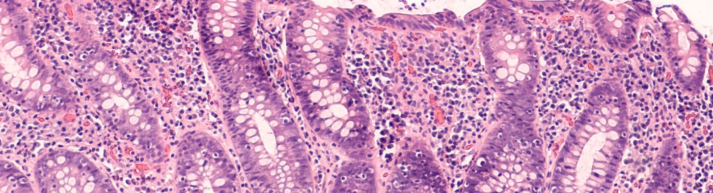 Lymphocytic Colitis - Causes, Symptoms, Diagnosis, Treatment, and Prevention