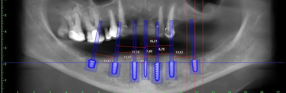 Maxillofacial / Jaw Reconstruction