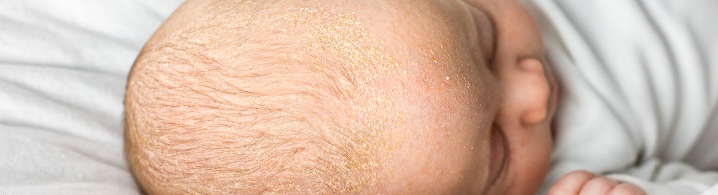 Menkes Disease - Causes, Symptoms, Diagnosis, Treatment, and Prevention