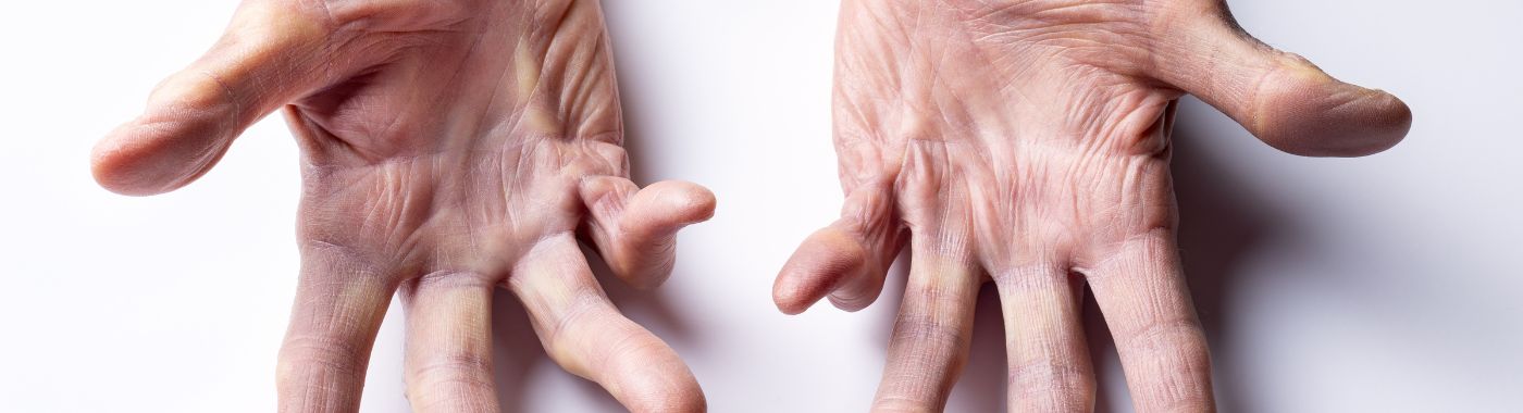 Mixed Connective Tissue Disease - Causes, Symptoms, Diagnosis, Treatment, and Prevention