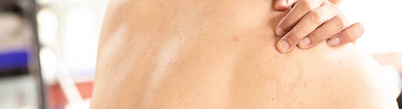 Morphea - Causes, Symptoms, Diagnosis, Treatment, and Prevention