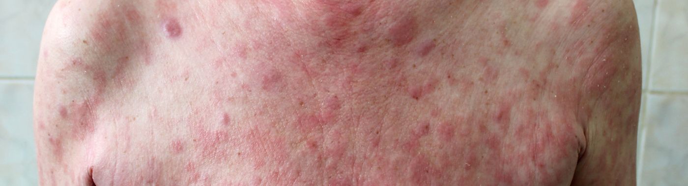 Mycosis Fungoides - Causes, Symptoms, Diagnosis, Treatment, and Prevention