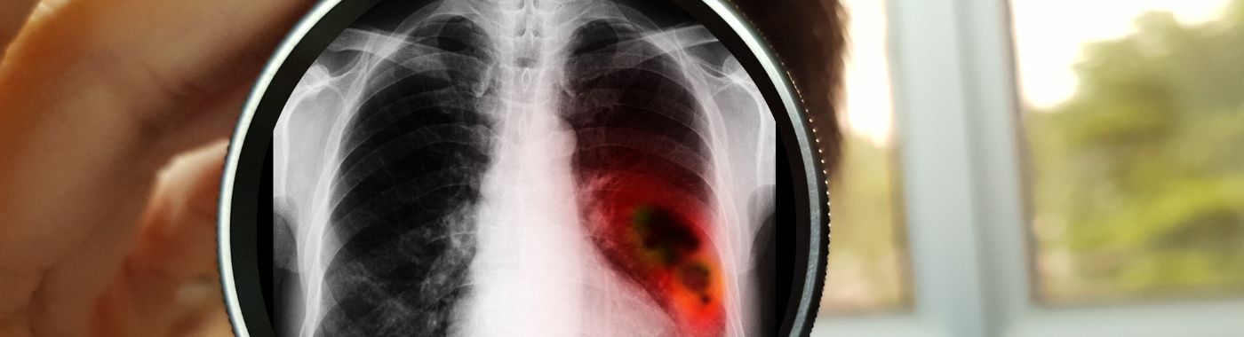 Nut Carcinoma - Causes, Symptoms, Diagnosis, Treatment, and Prevention