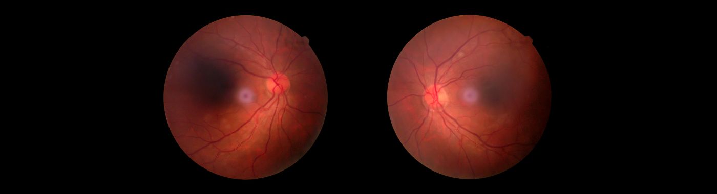 Ocular Ischemic Syndrome - Causes, Symptoms, Diagnosis, Treatment, and Prevention