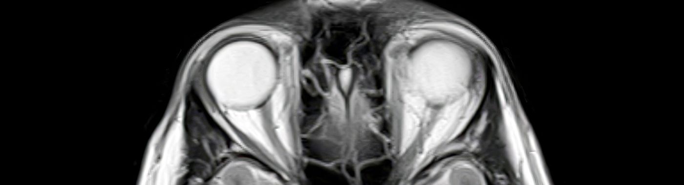 Optic Disc Drusen - Causes, Symptoms, Diagnosis, Treatment, and Prevention