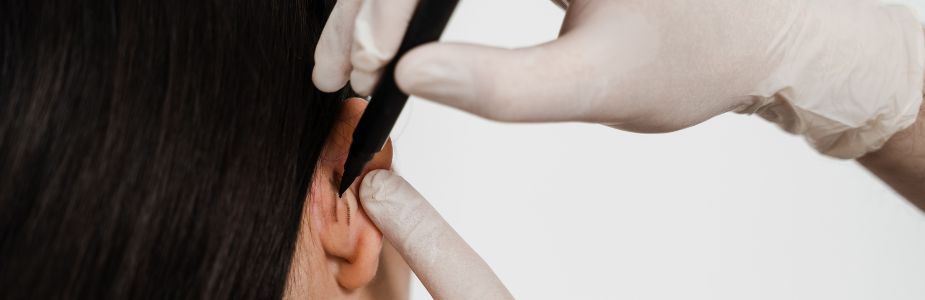 Otoplasty (Ear Reshaping)