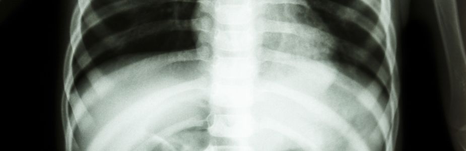 Paediatric Thoracic Surgery