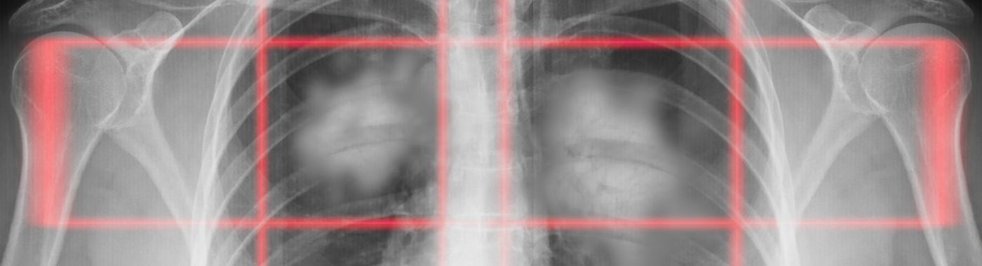 Pancoast Tumor - Causes, Symptoms, Diagnosis, Treatment, and Prevention